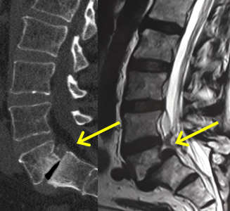 DR EVERARDO ESCAMILLA NEUROCIRUJANO TEPIC EXPERTO EN CIRGIA DE COLUMNA VERTEBRAL CIATICA CERVICAL LUMBAR FRACTURA HERNIA DE DISCO LISTESIS