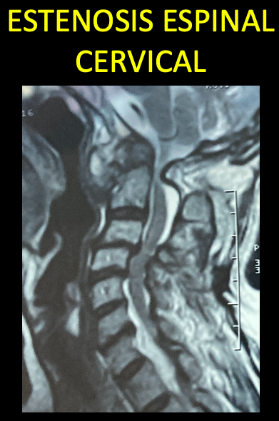 DR EVERARDO ESCAMILLA NEUROCIRUJANO TEPIC EXPERTO EN CIRGIA DE COLUMNA VERTEBRAL CIATICA CERVICAL LUMBAR FRACTURA HERNIA DE DISCO LISTESIS CIFOPLASTIA CERVICAL