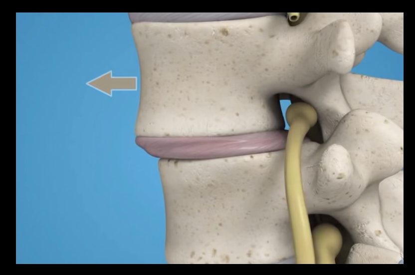 DR EVERARDO ESCAMILLA NEUROCIRUJANO TEPIC EXPERTO EN CIRGIA DE COLUMNA VERTEBRAL CIATICA CERVICAL LUMBAR FRACTURA HERNIA DE DISCO LISTESIS