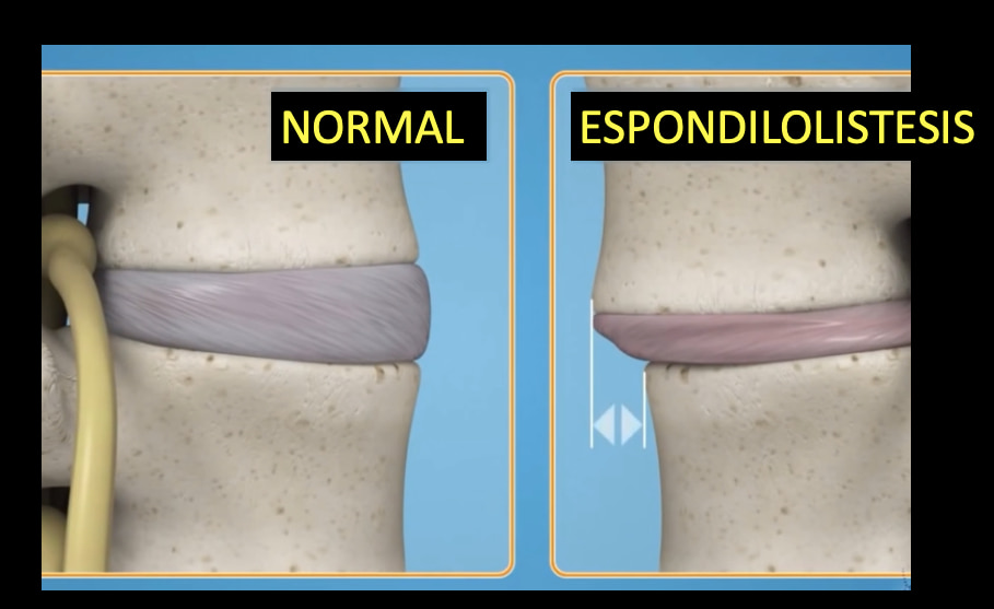 DR EVERARDO ESCAMILLA NEUROCIRUJANO TEPIC EXPERTO EN CIRGIA DE COLUMNA VERTEBRAL CIATICA CERVICAL LUMBAR FRACTURA HERNIA DE DISCO LISTESIS