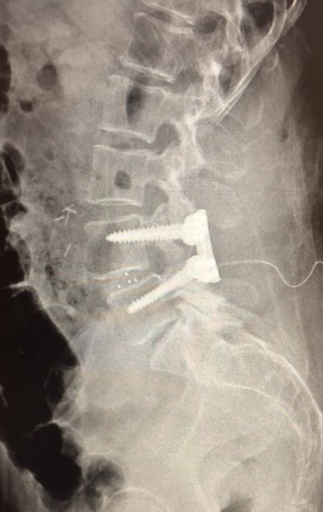 DR EVERARDO ESCAMILLA NEUROCIRUJANO TEPIC EXPERTO EN CIRGIA DE COLUMNA VERTEBRAL CIATICA CERVICAL LUMBAR FRACTURA HERNIA DE DISCO LISTESIS